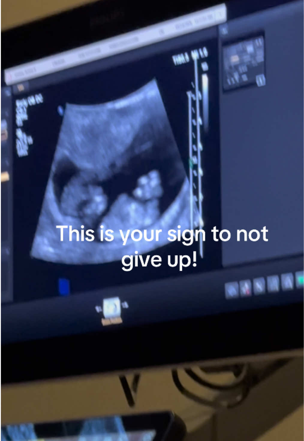 @Ashley Gorton | IVF Journey