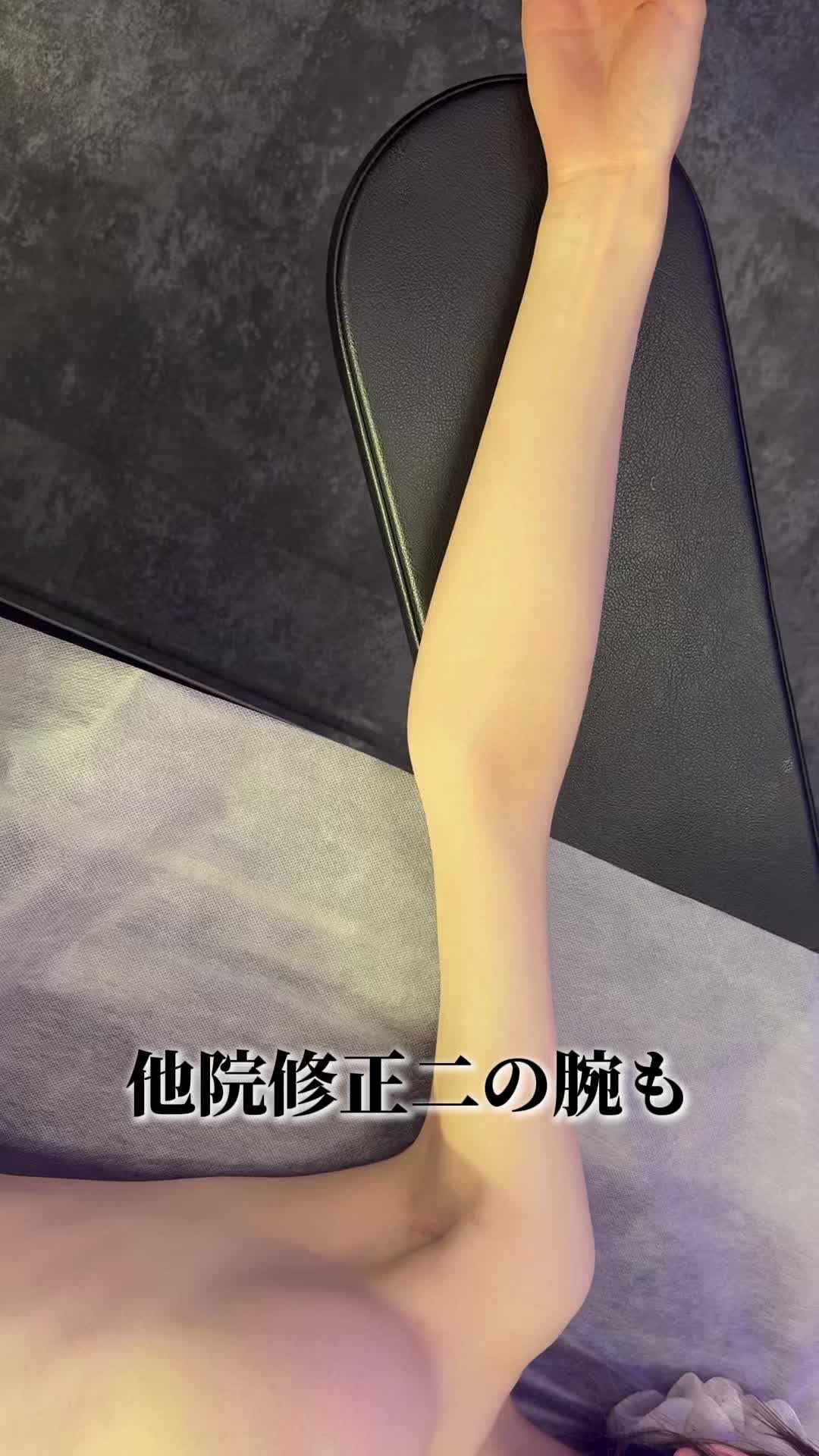 @SHIN/森脇 進の二の腕脂肪吸引・豊胸