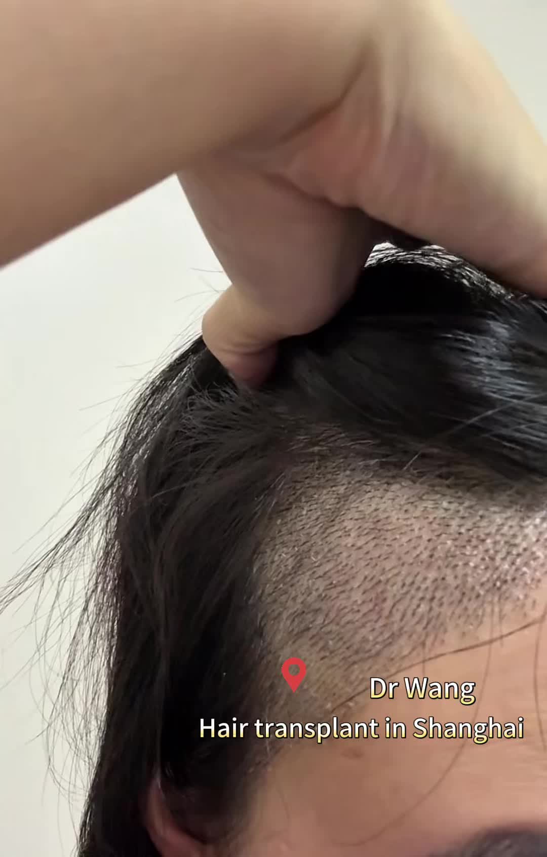 @HAIR TRANSPLANT WANG🇨🇳