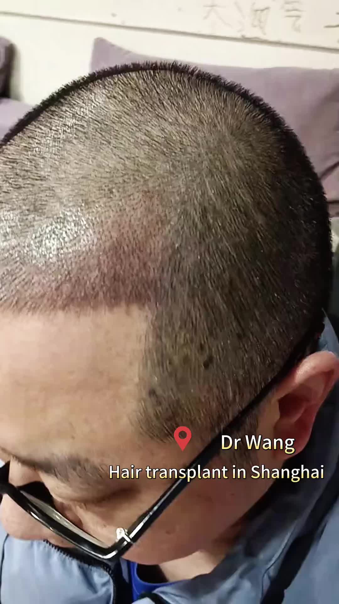 @HAIR TRANSPLANT WANG🇨🇳