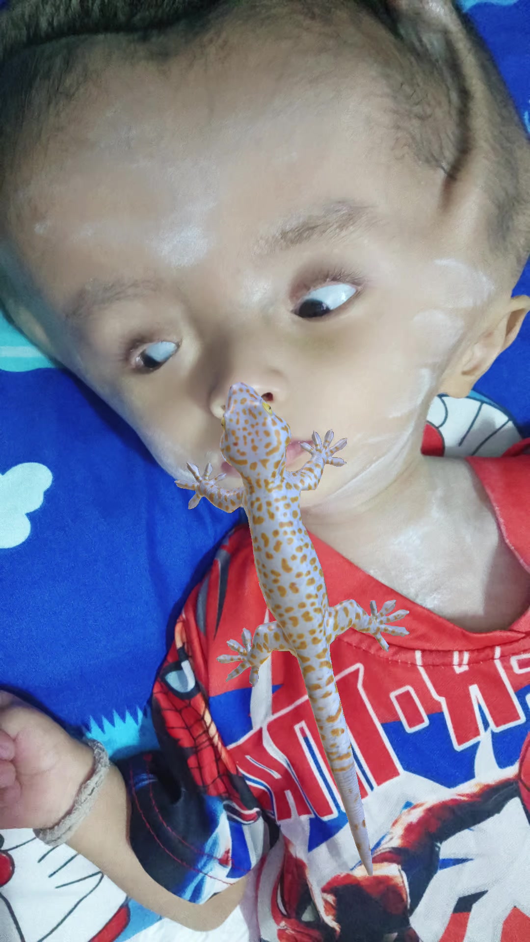 @บู้บี้เด็กหัวโตมีน้ำในโพรงสมอง
