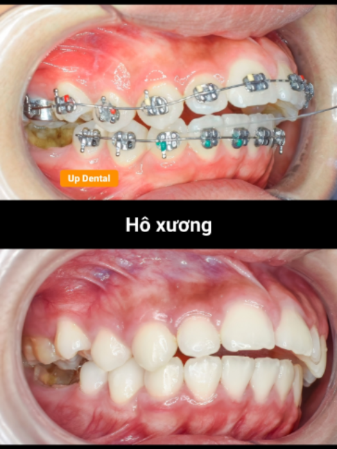 @Nha khoa niềng răng Up Dental
