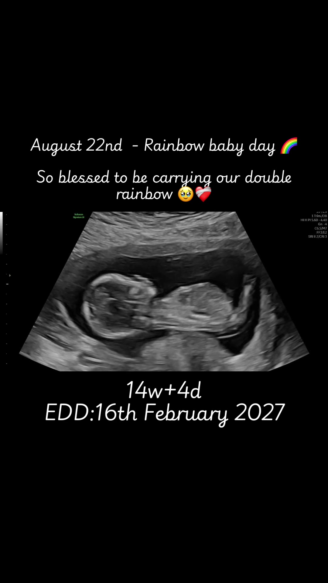 @Stacey🌸| Pregnancy after loss