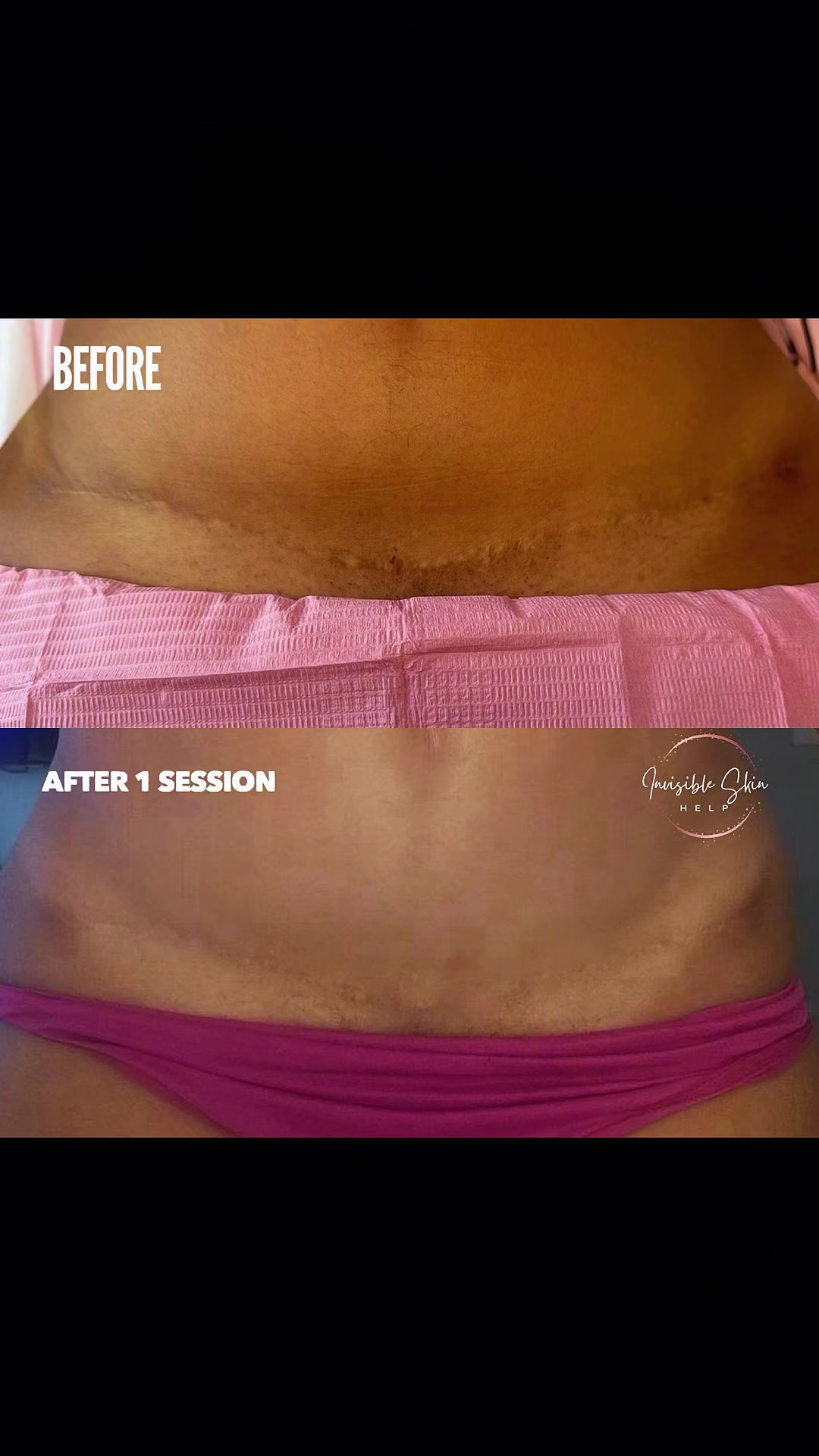 @Invisibleskinhelp
