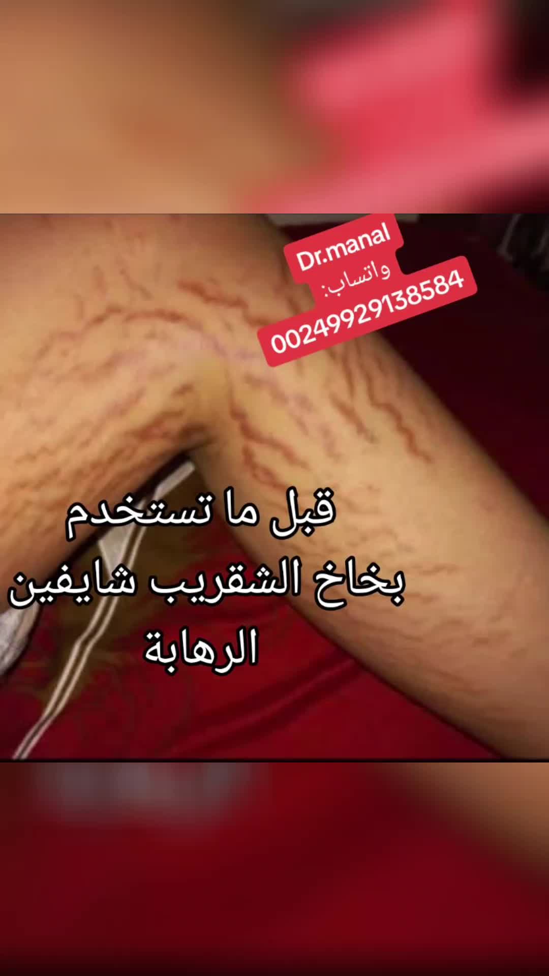 @drmanal " لعلاج التشققات "