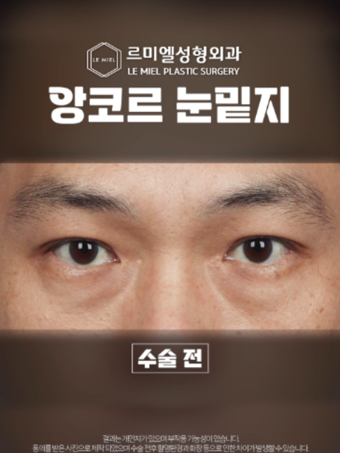 @르미엘성형외과