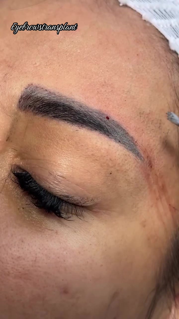 @Eyebrows Transplant