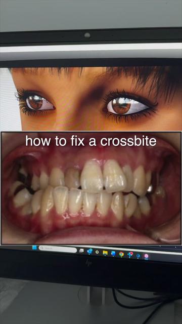 @The Braces Guy