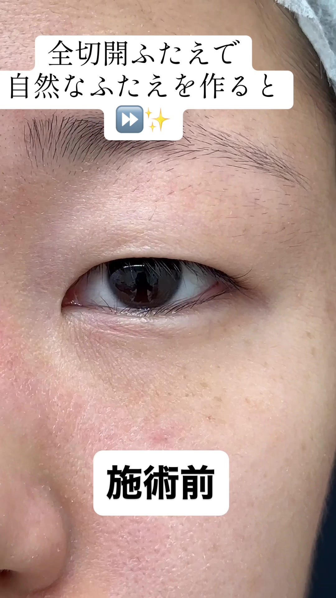 @二重整形埋没法/広島美容外科メイプルクリニック院長 吉本如良