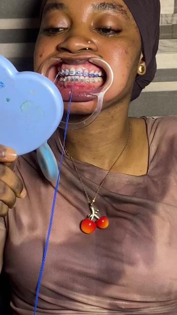 @Braces.bymavi|Smile Aesthetics