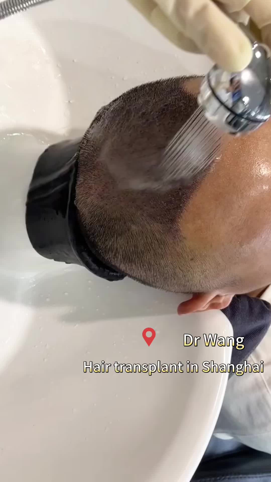 @HAIR TRANSPLANT WANG🇨🇳