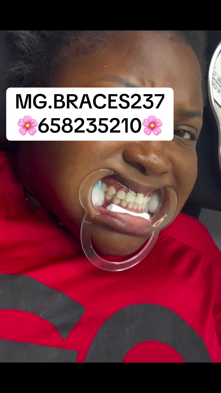 @MG BRACES