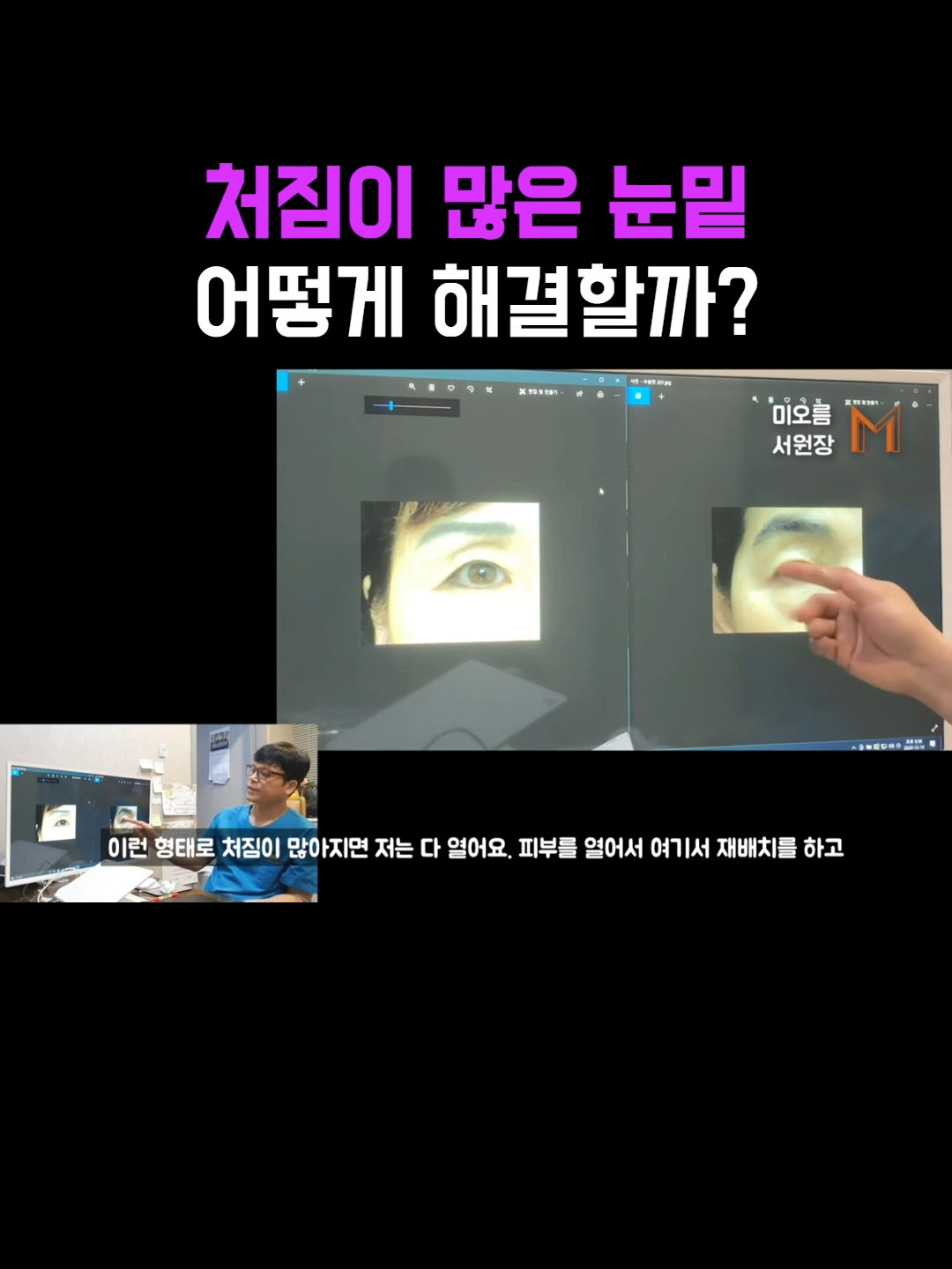 @미오름성형외과