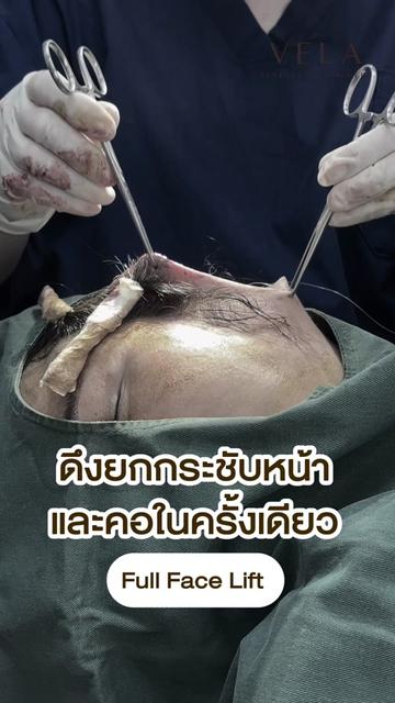 @เวลาคลินิก ตาสองชั้น ถุงใต้ตา