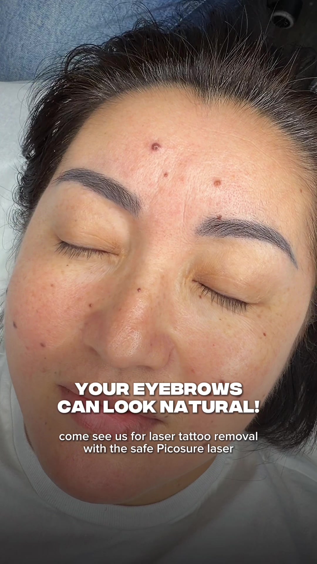 @Safe Eyebrows Tattoo Removal🗽