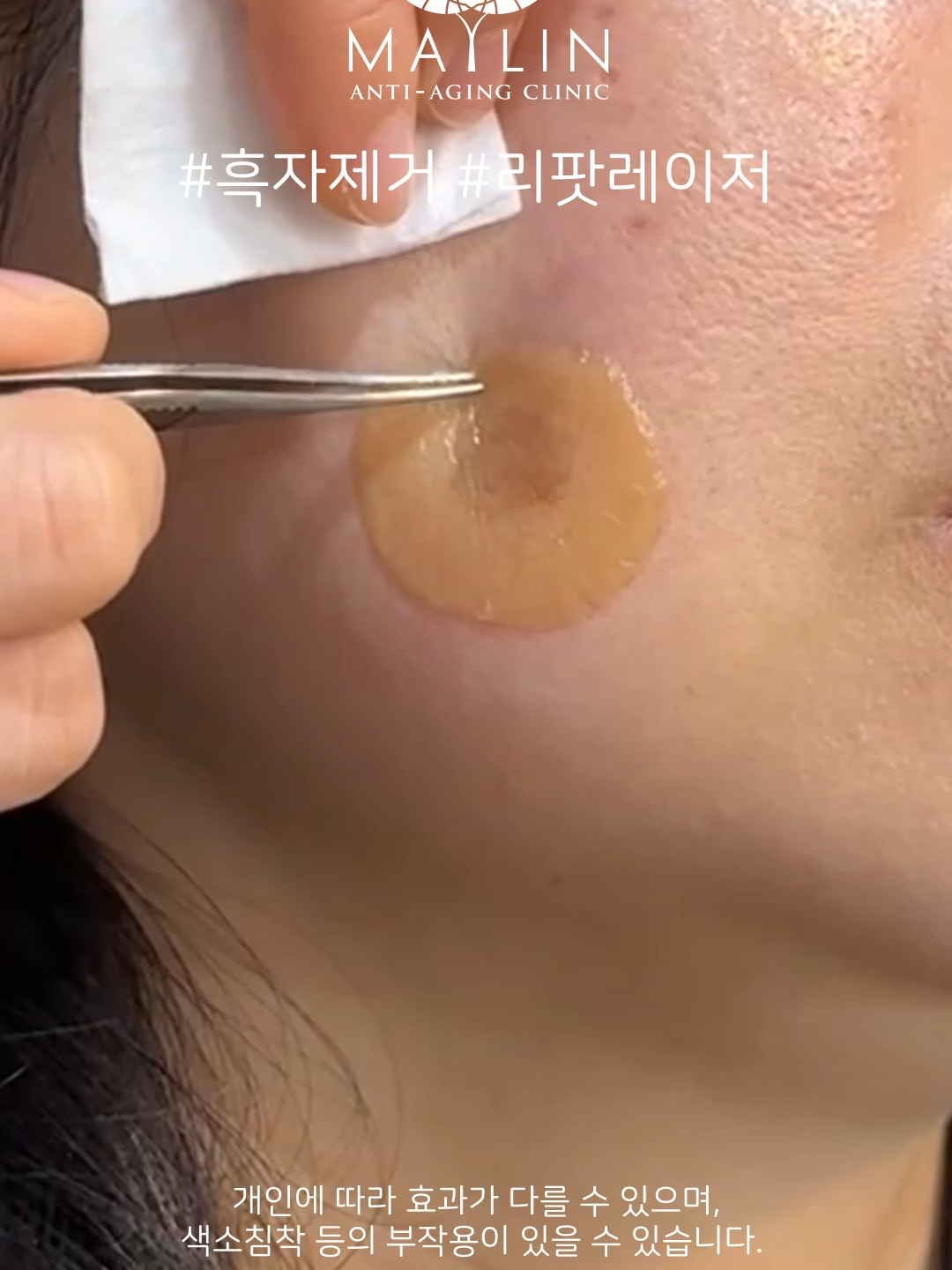 @메이린의원대구점