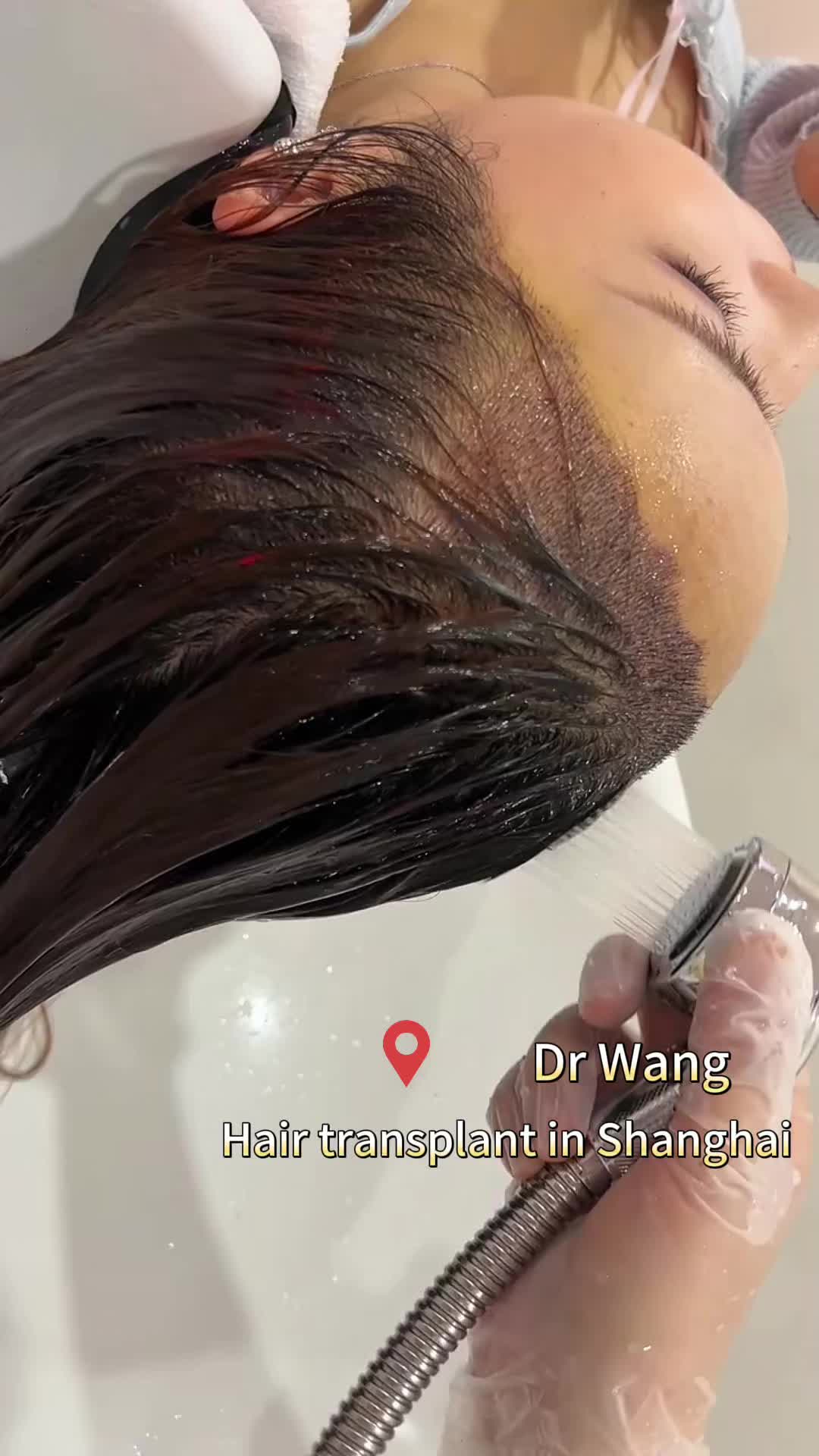 @HAIR TRANSPLANT WANG🇨🇳