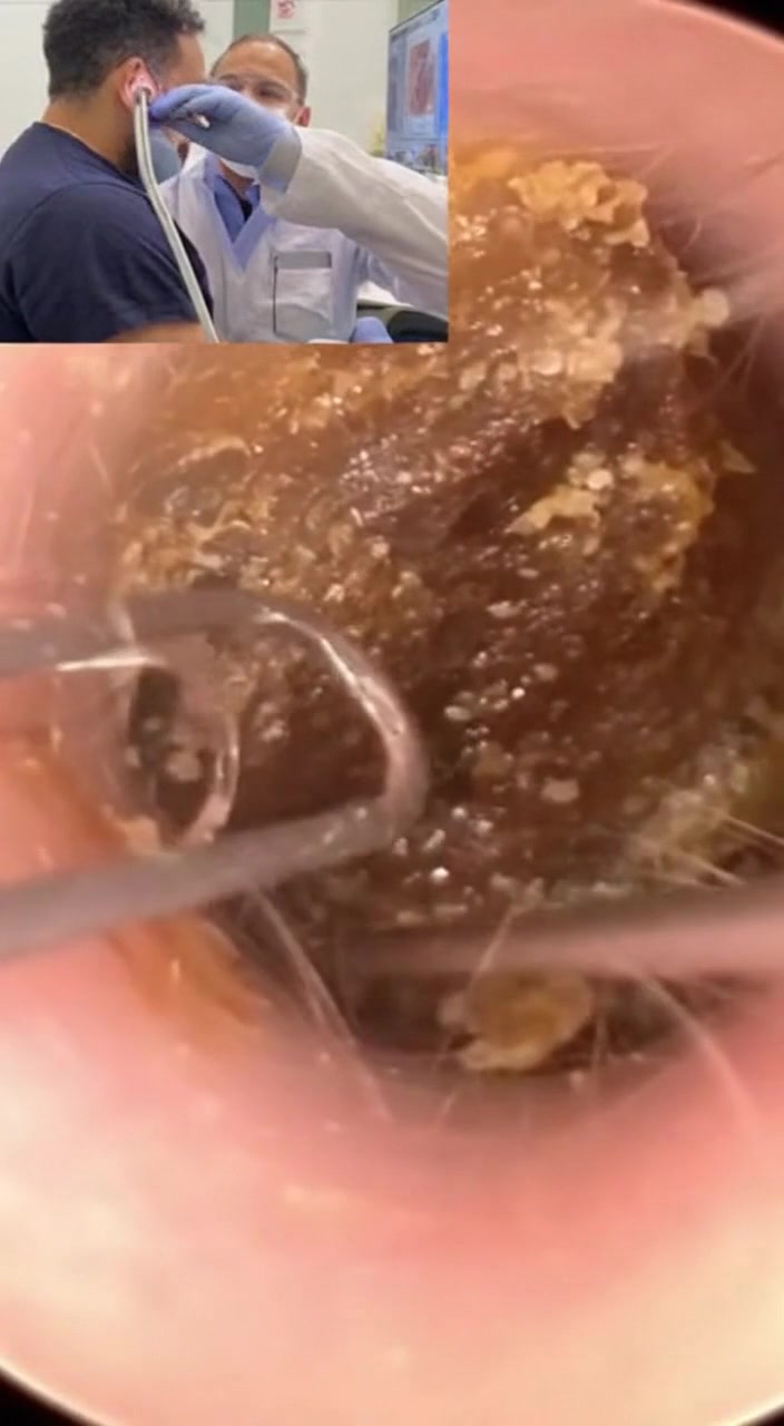 @Ear Cleaning