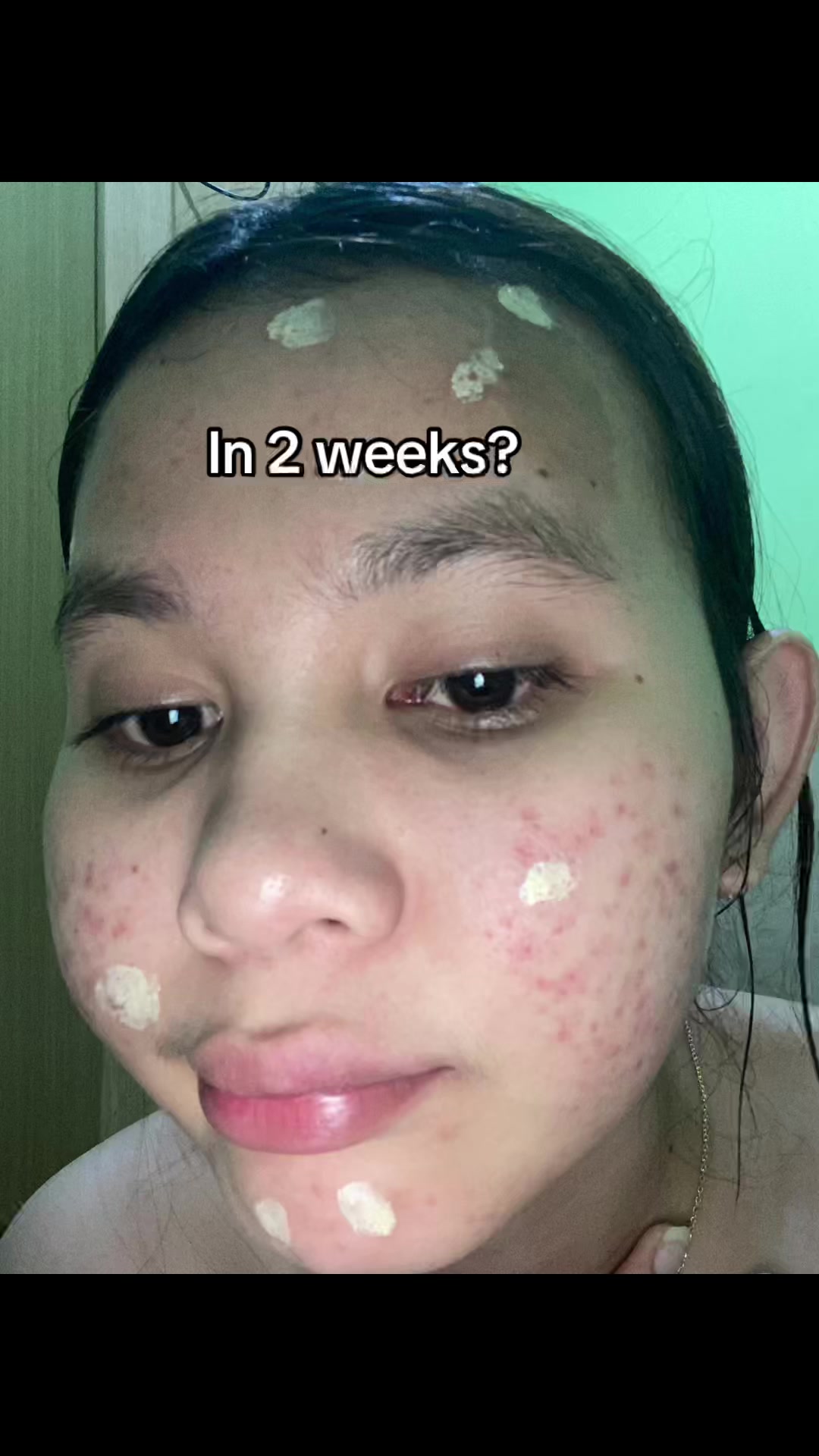 @Natha | Acne fighter