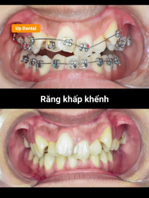 @Nha khoa niềng răng Up Dental