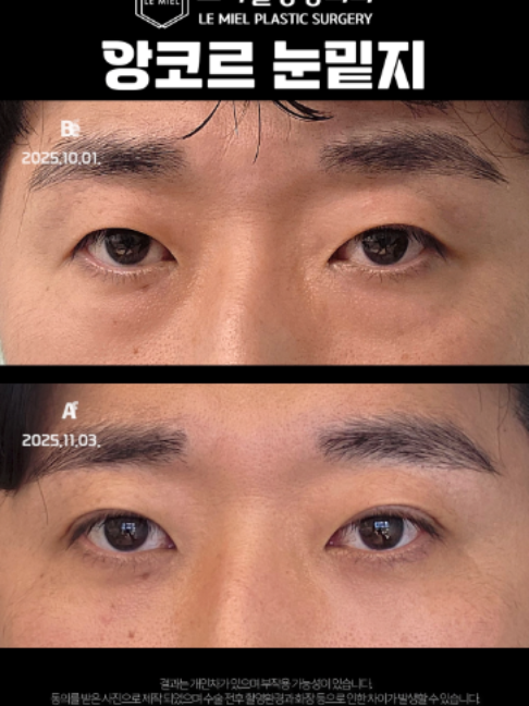 @르미엘성형외과