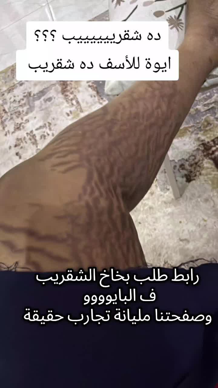 @drmanal " لعلاج التشققات "