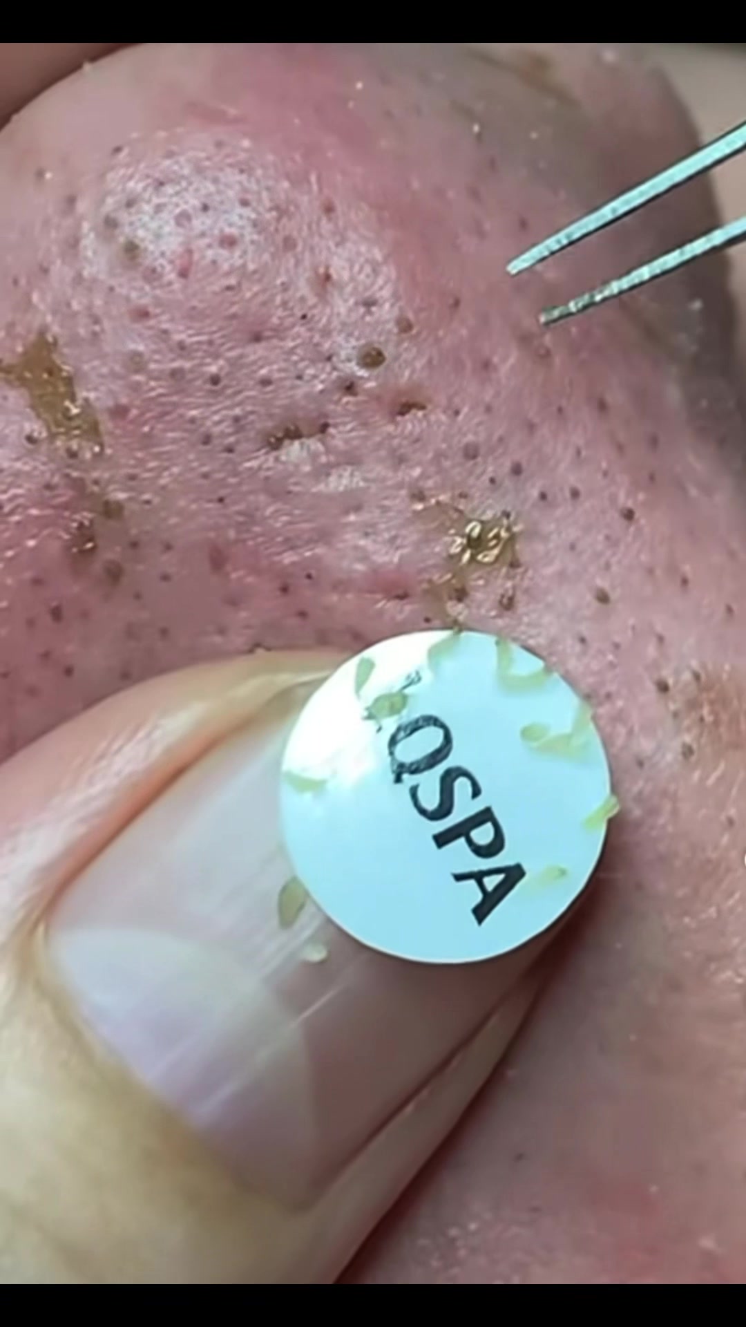 @pimplepopperasmr