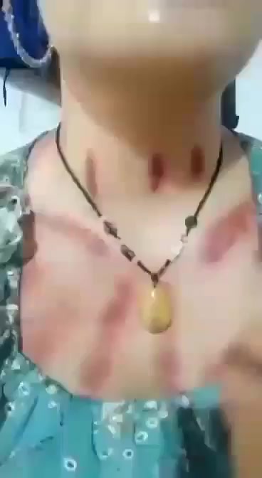 @thích cạo gió