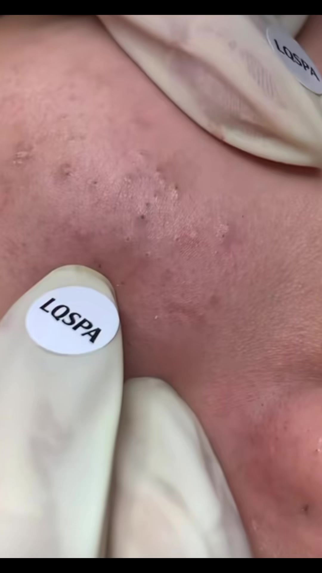 @pimplepopperasmr