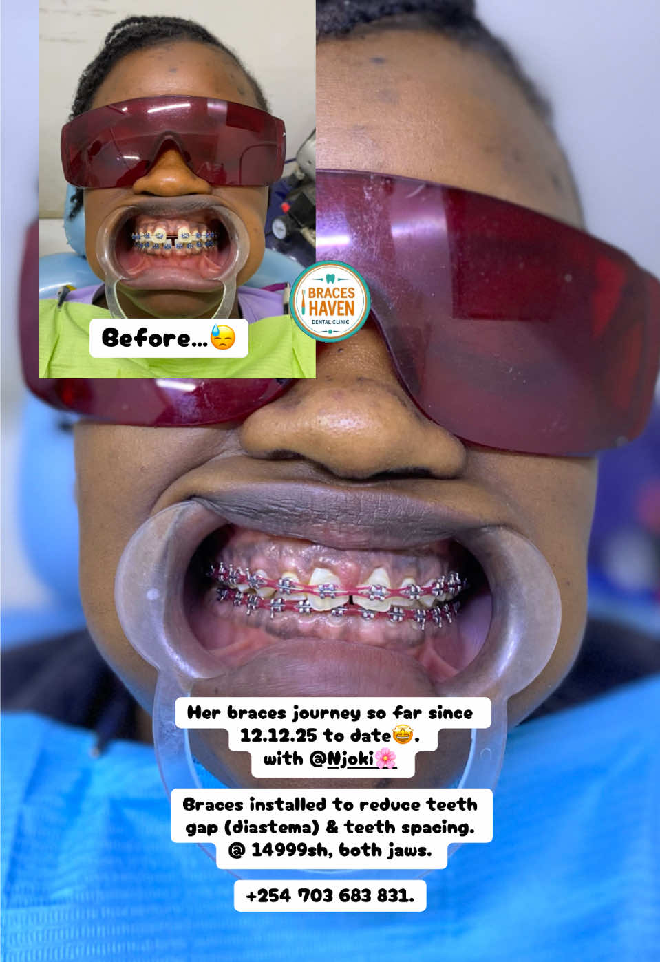 @Braces Haven Nairobi Dental