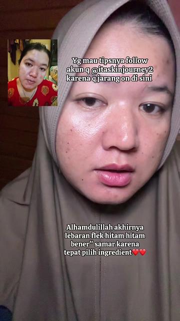 @ita_skinjourney