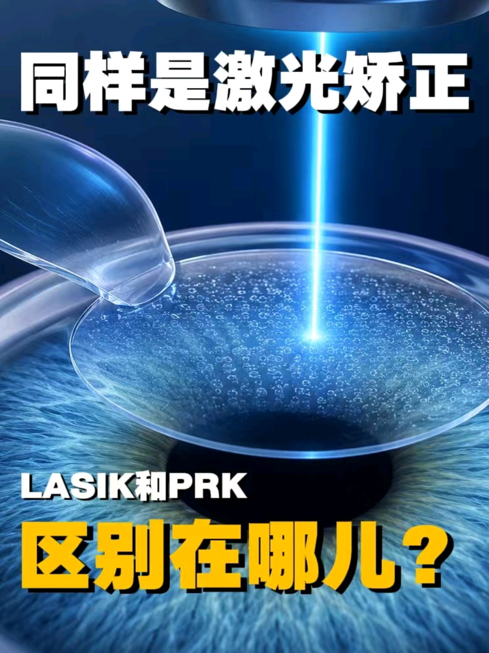 @🇺🇸西雅图/波特兰 King  Lasik 近视老花手术