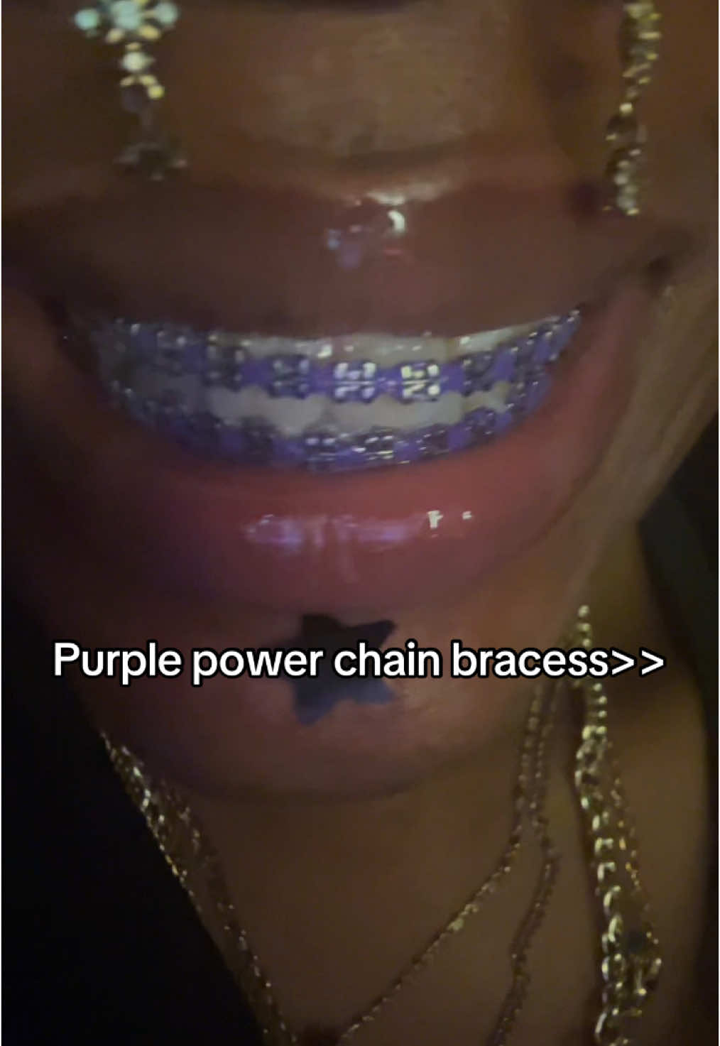 @Princessbracesplug🫶🏽🫆