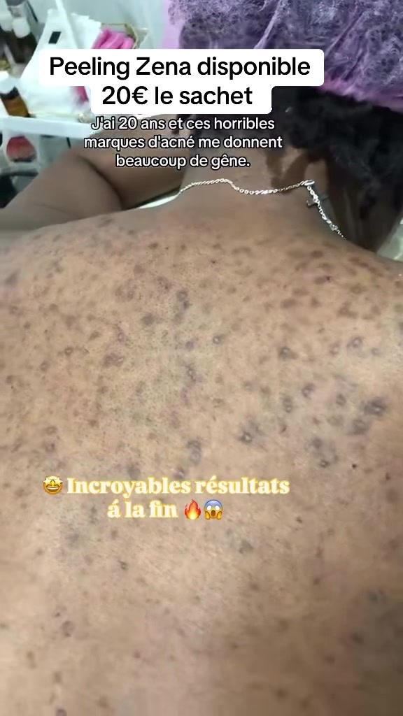 @peeling_zena