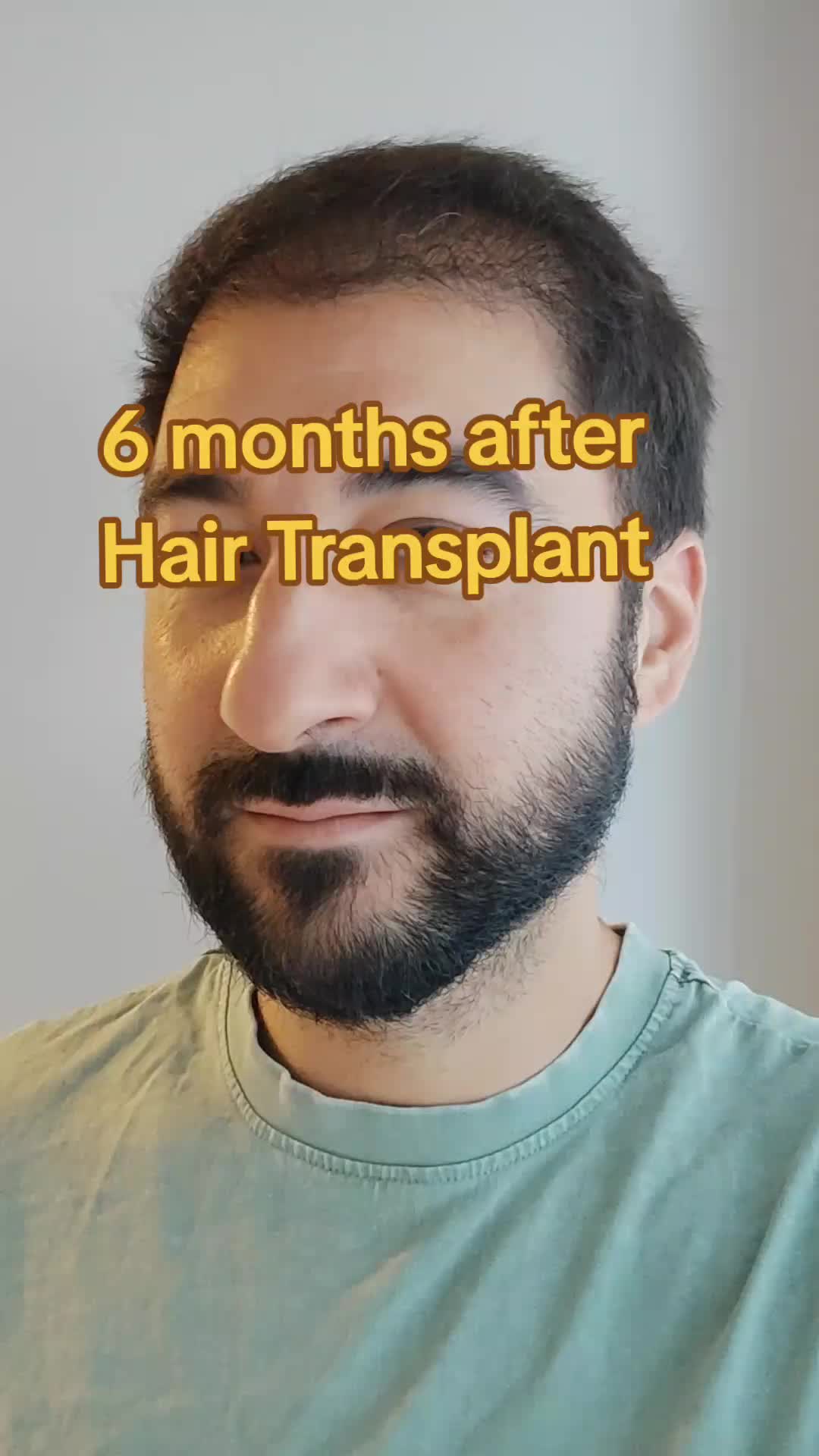 @My hair transplant
