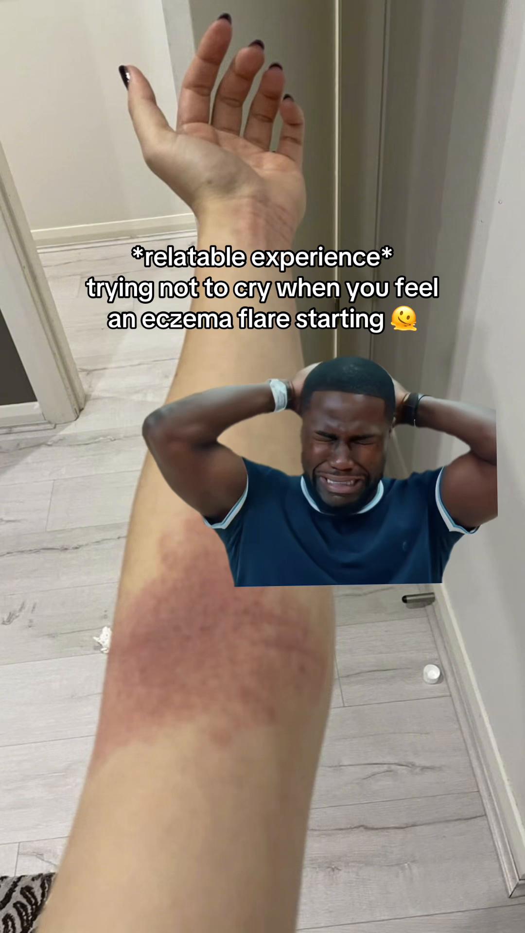 @Eczema Diaries USA & UK