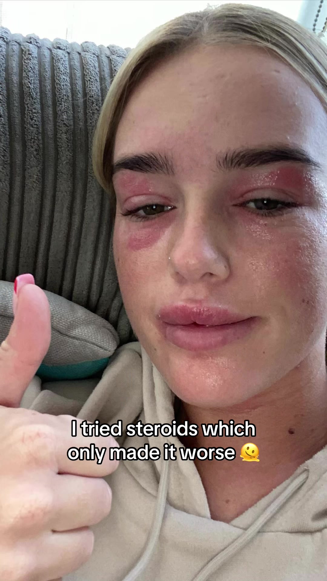 @Eczema Diaries USA & UK