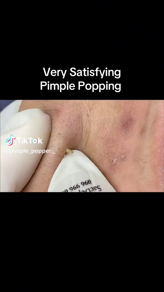 @Papa Pimple