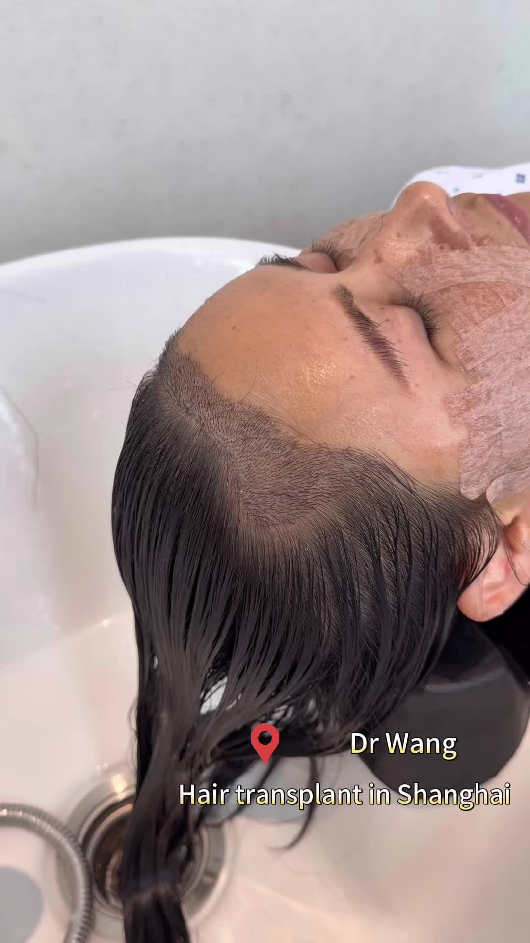 @HAIR TRANSPLANT WANG🇨🇳