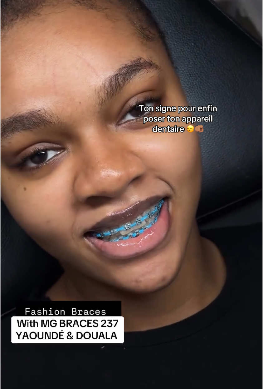 @MG BRACES