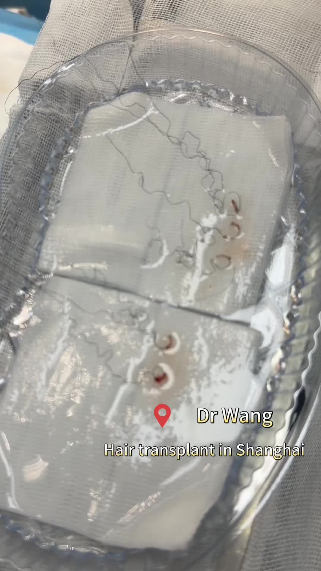 @HAIR TRANSPLANT WANG🇨🇳