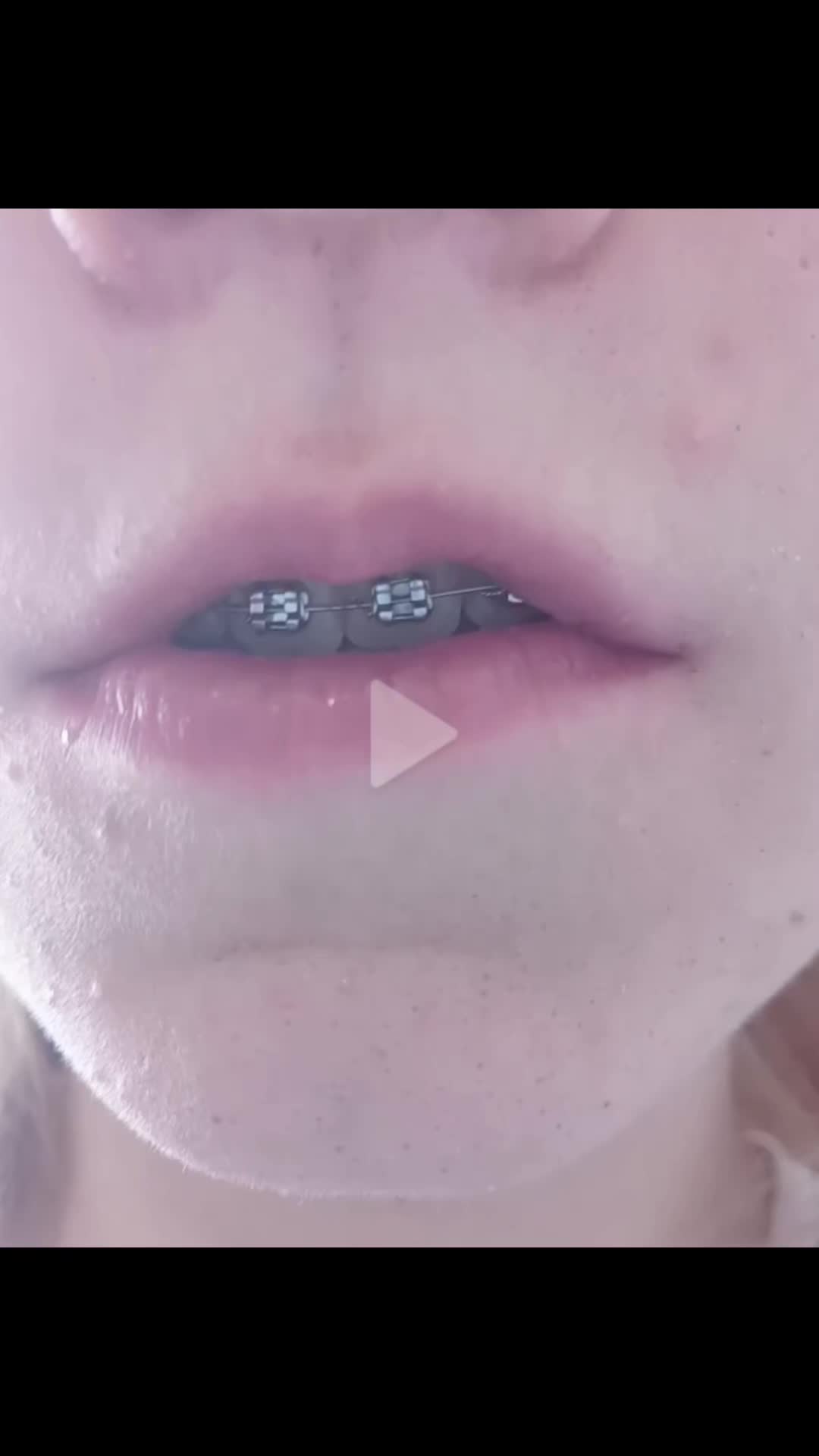@Zahnspangen Club/  Braces Site