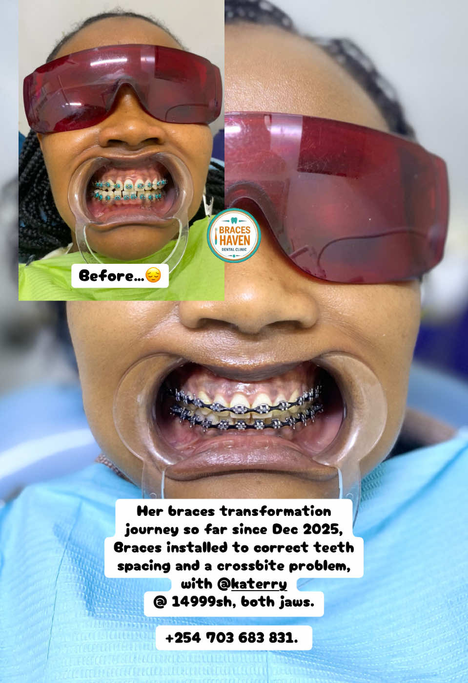 @Braces Haven Nairobi Dental