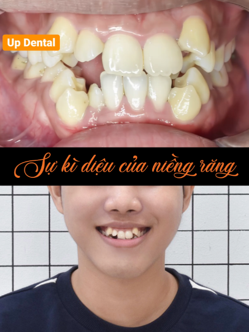 @Nha khoa niềng răng Up Dental