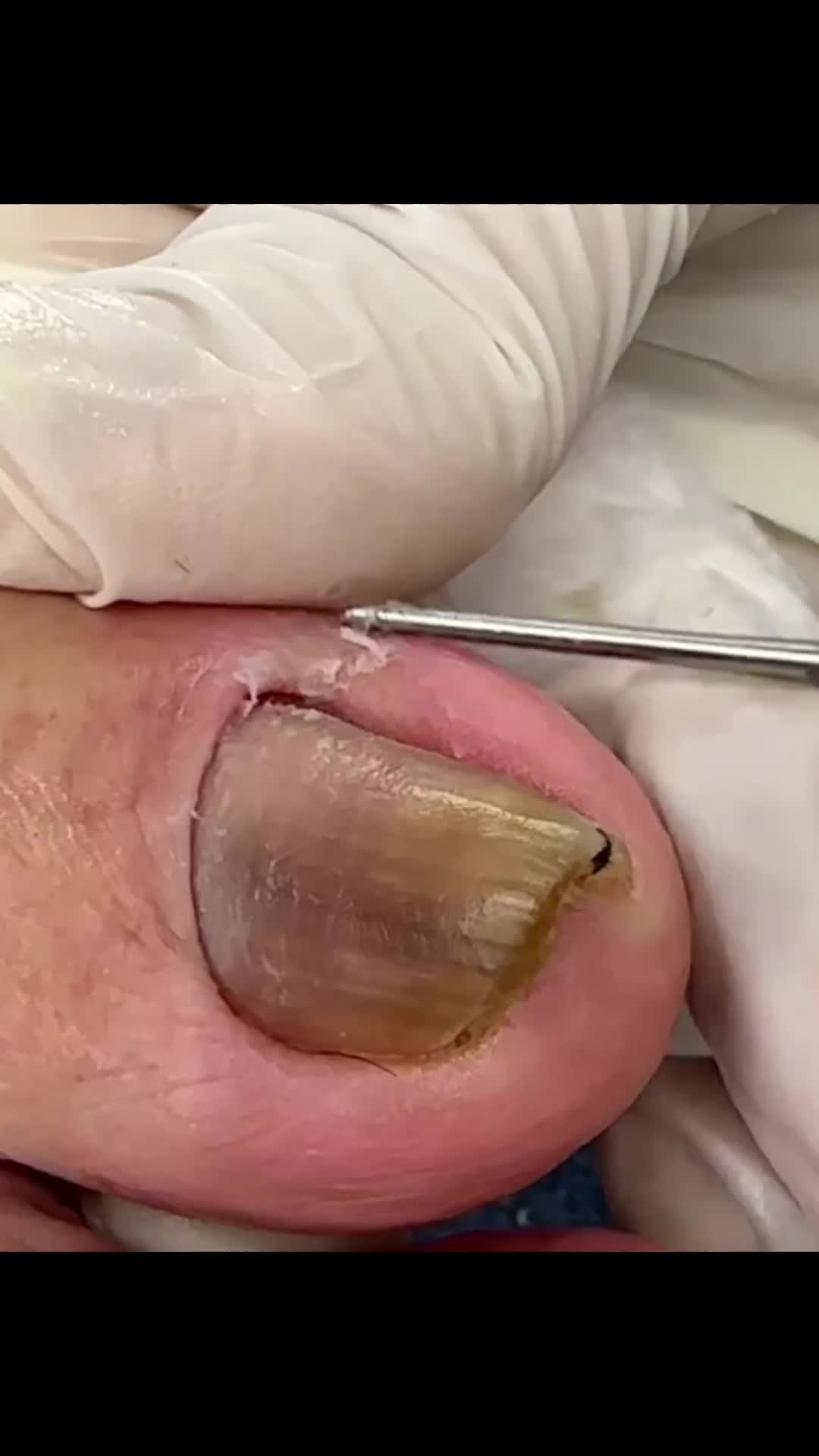 @Toenails.clips