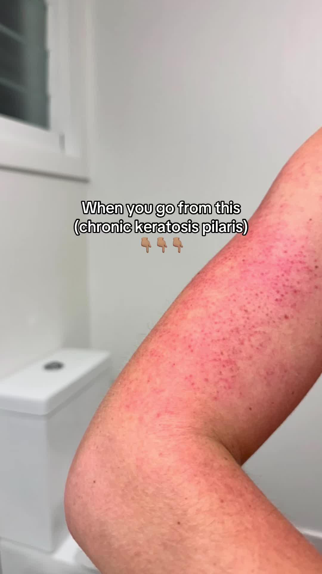 @Eczema Diaries USA & UK