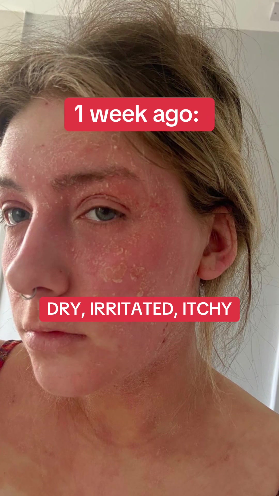 @Eczema Diaries USA & UK