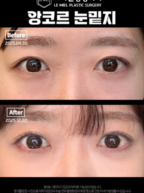 @르미엘성형외과