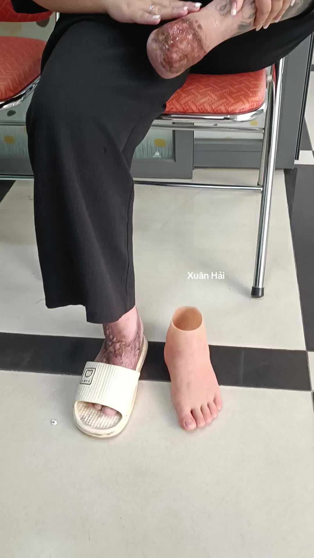 @Hải R&acirc;u Tay Ch&acirc;n Giả
