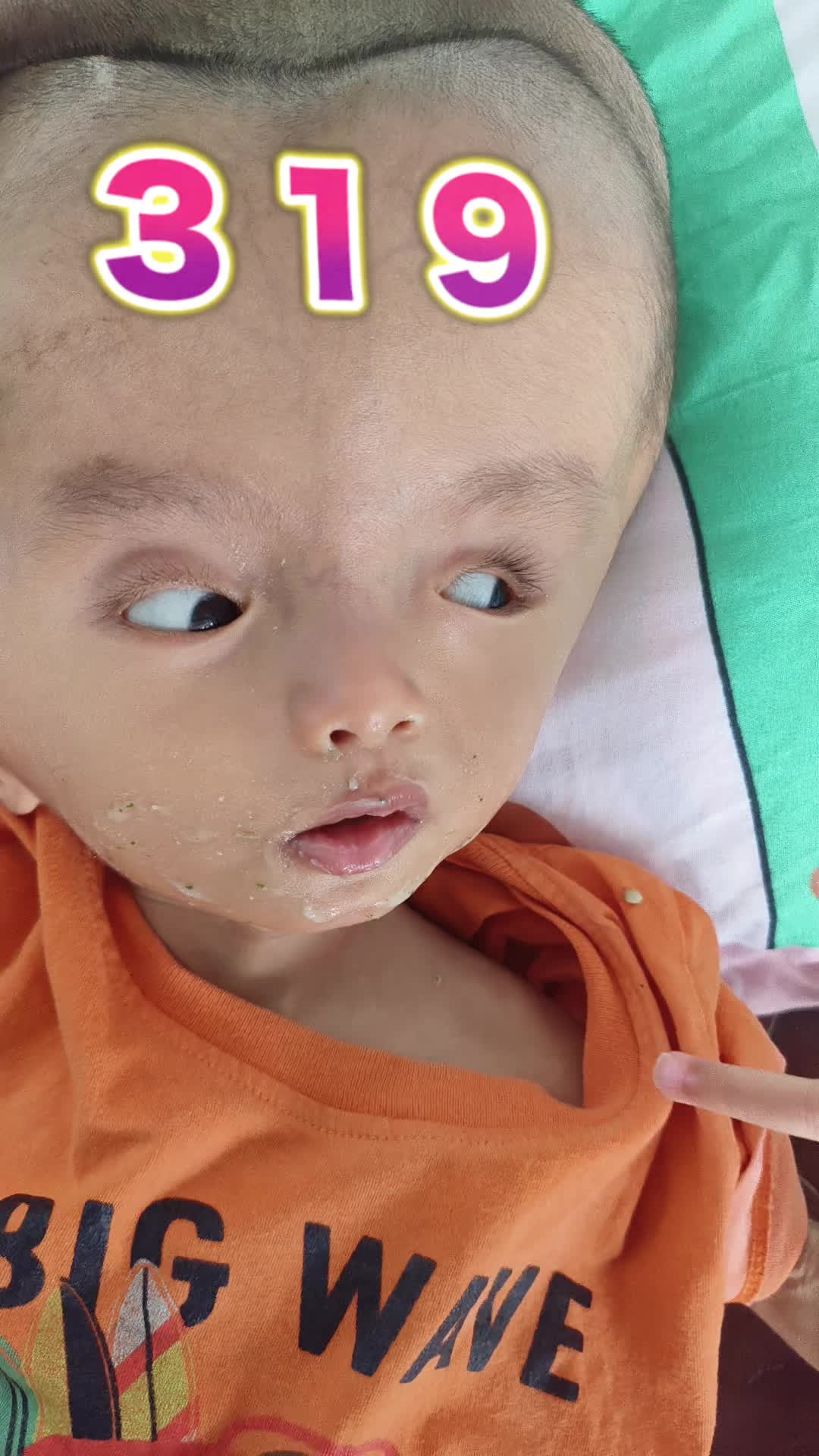 @บู้บี้เด็กหัวโตมีน้ำในโพรงสมอง